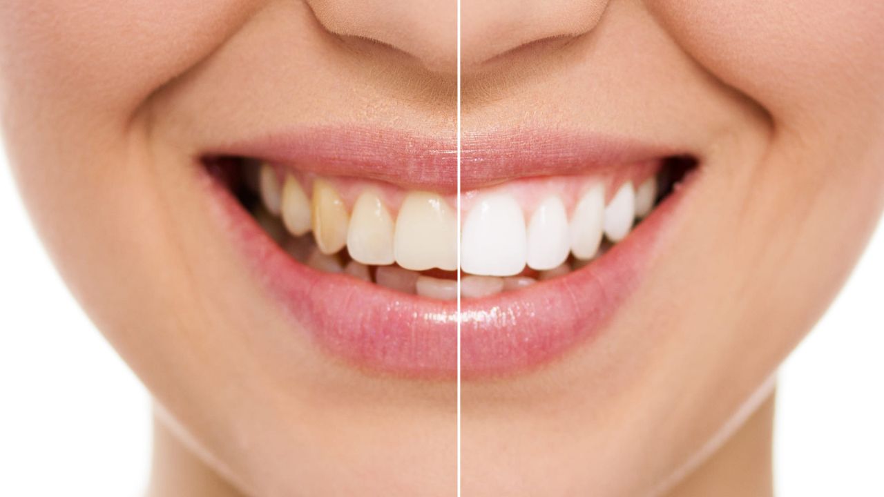 How Teeth Whitening Dry Strips is Revolutionizing Oral Care